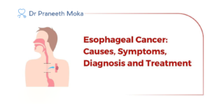 Esophageal cancer specialist