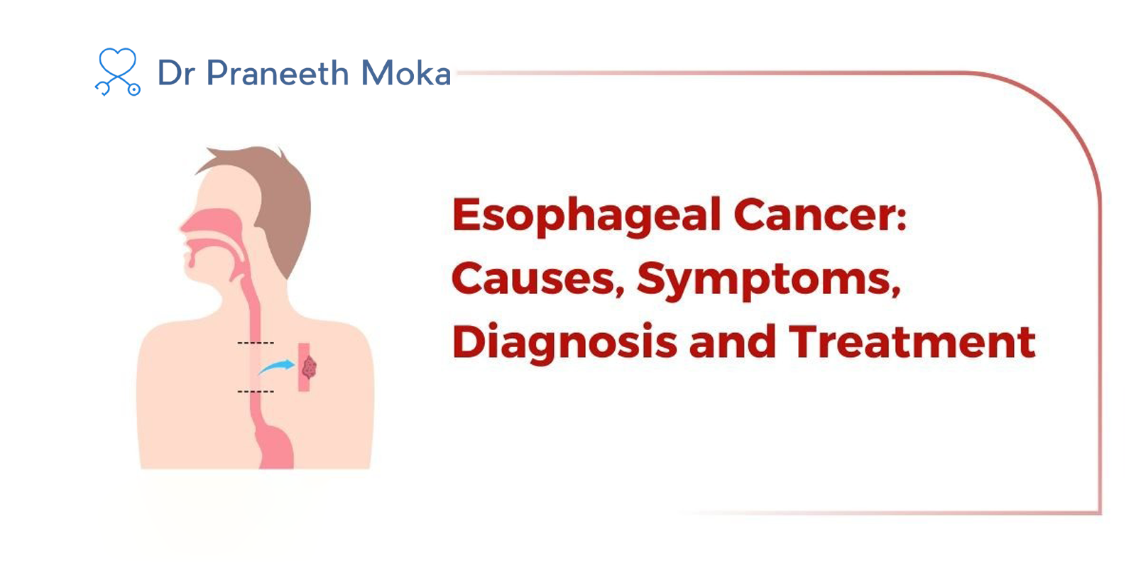 Esophageal cancer specialist
